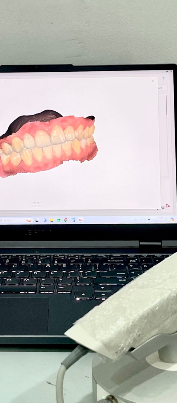 3D Intraoral Scanner